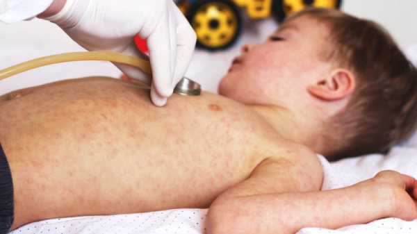 Romania declares measles epidemic | INFBusiness.com